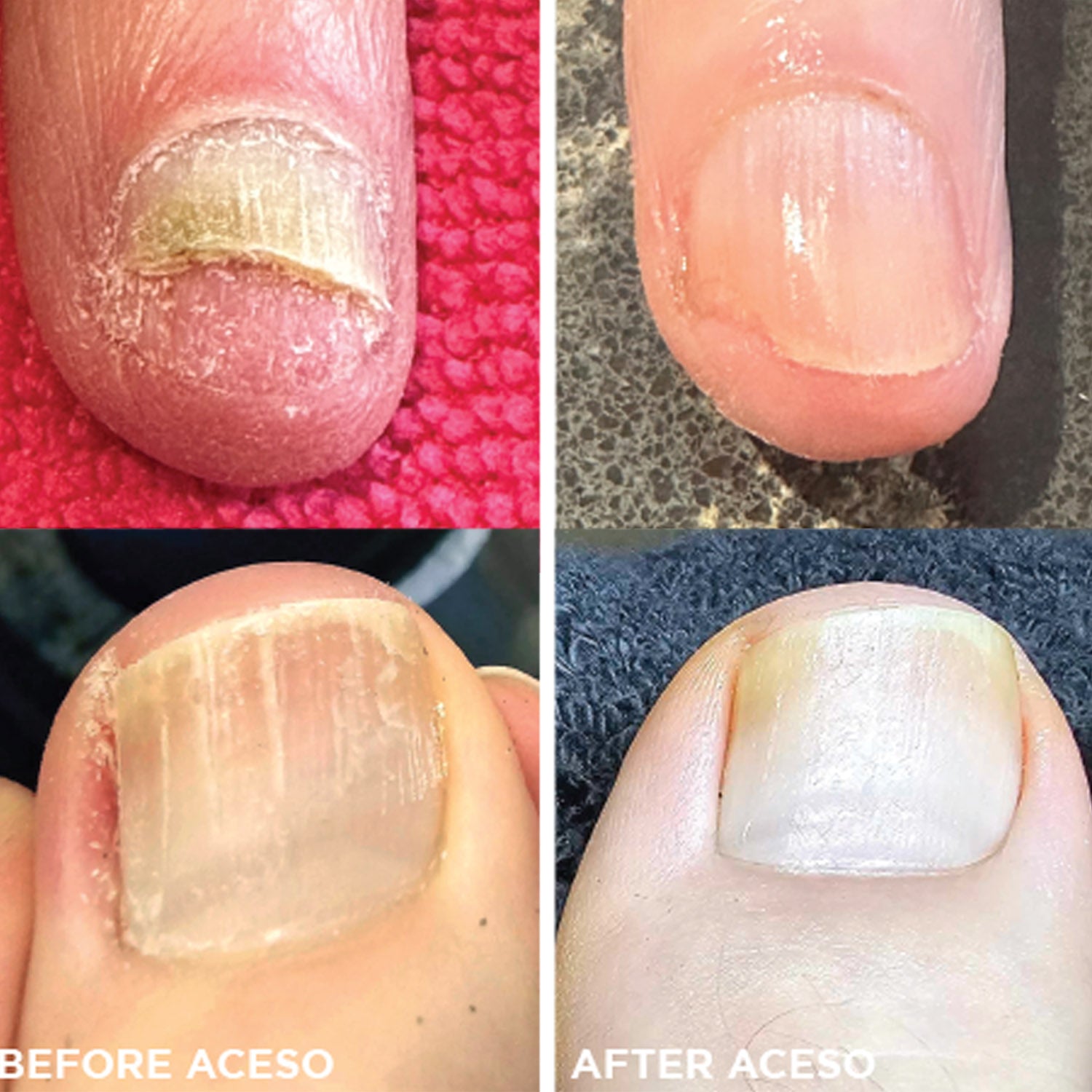Aceso Step One 2 fl oz 04696