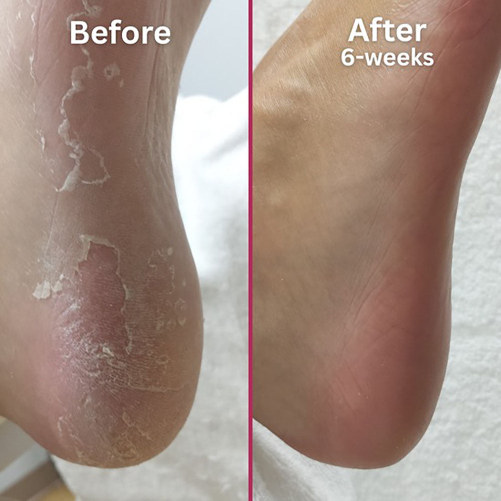 Footlogix Peeling Skin Formula Mousse (7) 4.23 oz. 20131
