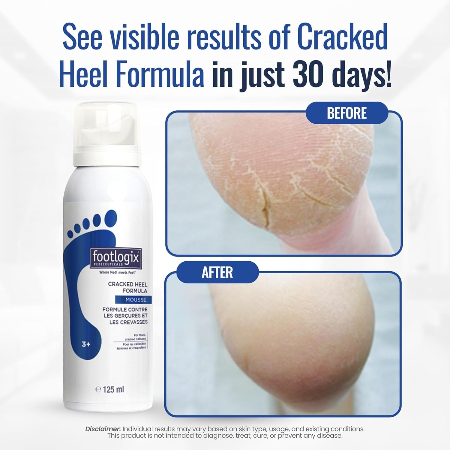 Footlogix #3+ Cracked Heel Formula Mousse 4.23 oz. 04131